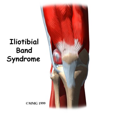 Iliotibial Band Syndrome